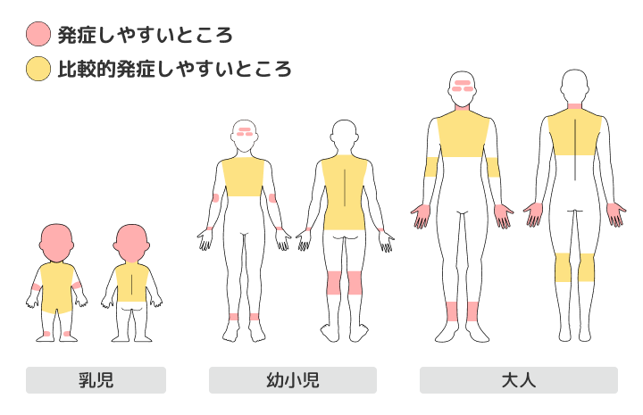 アトピー性皮膚炎を発症しやすい部位