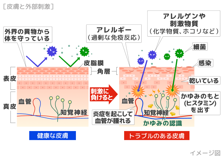 かぶれ・湿疹とは