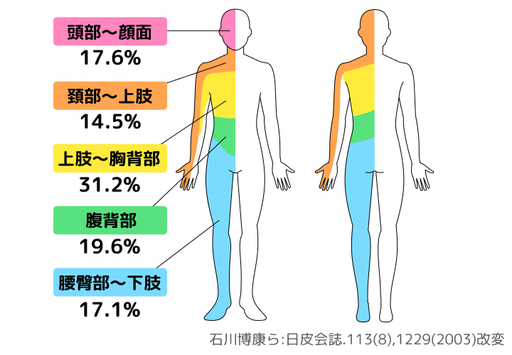 上半身に発症する人が半数以上