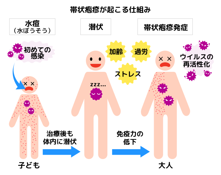 水ぼうそうと同じウイルスが原因