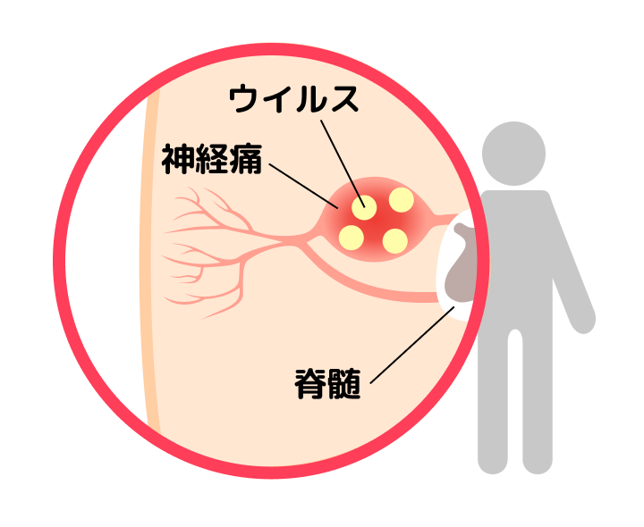 帯状疱疹が起こるメカニズム ②潜伏期間